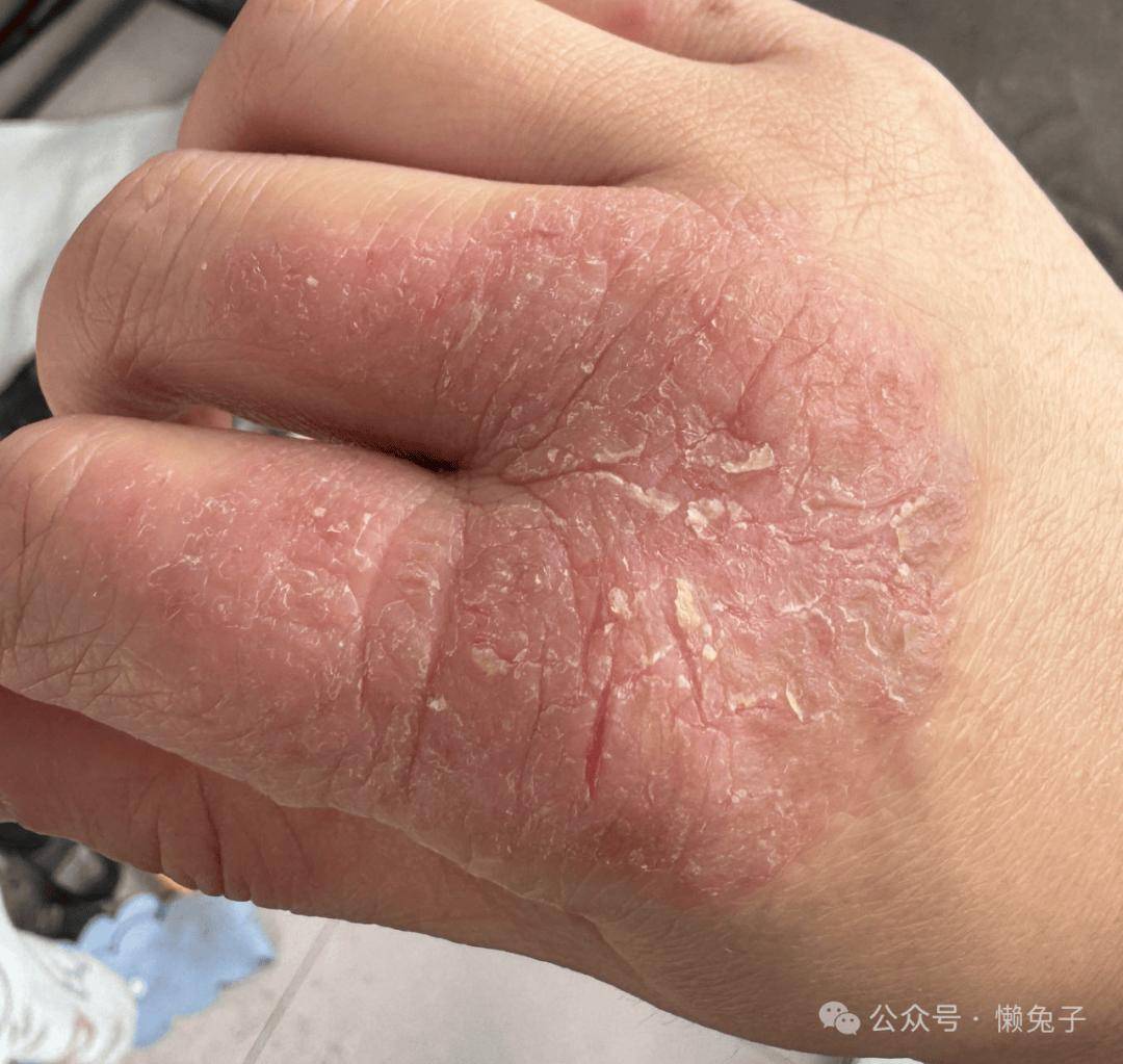 医案:蕲春艾灸学习,意外治好手上严重湿疹(之前惨不忍睹)