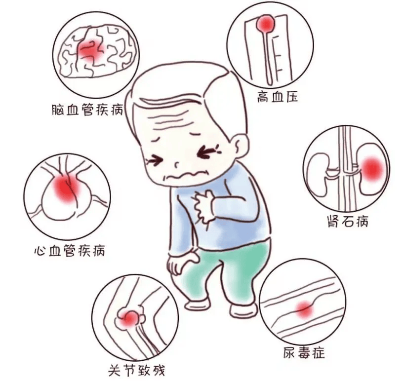 【健康科普】高尿酸=痛风?降尿酸饮食运动攻略来啦!