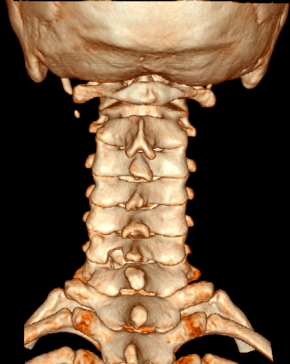 我院骨科医院脊柱外科专业组组长,主任医师梁秋冬通过详细的问诊及查