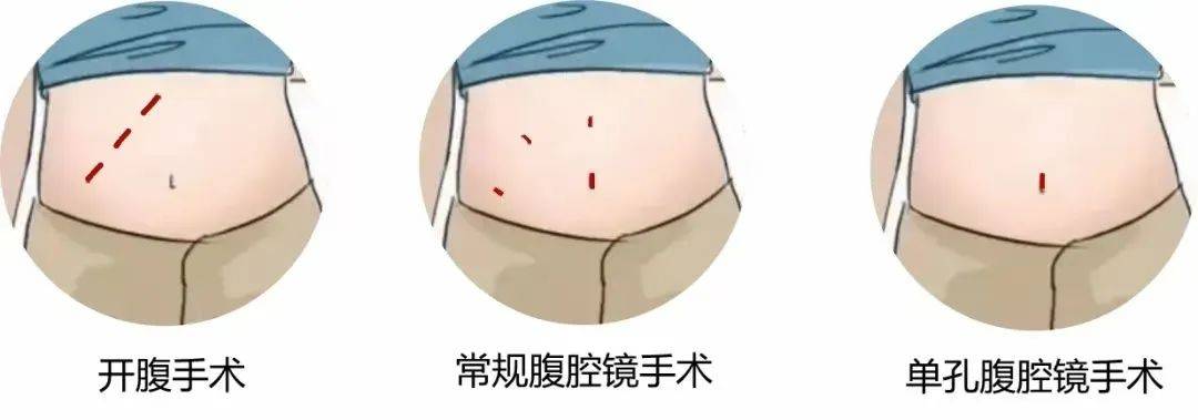 南通四院常规开展经脐单孔腹腔镜胆囊切除术_患者_手术_切口