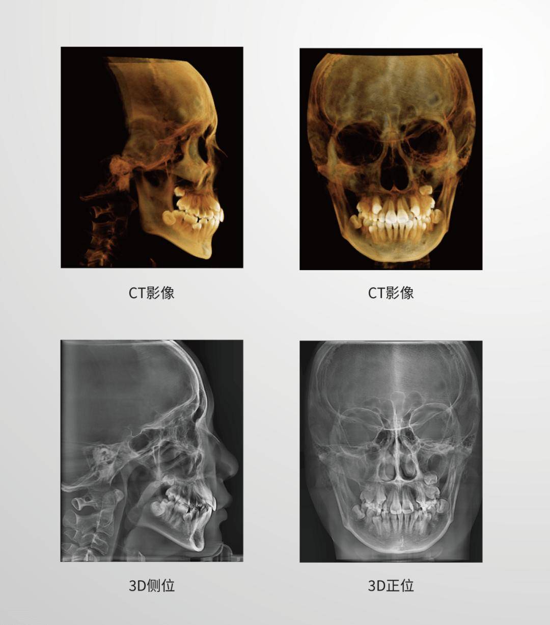 硬腭CT图片