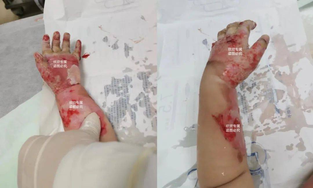 2岁女童手指险遭截肢,只因大人这个疏忽!医生:有娃家庭一定要重视