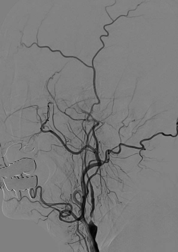 椎动脉造影图图片