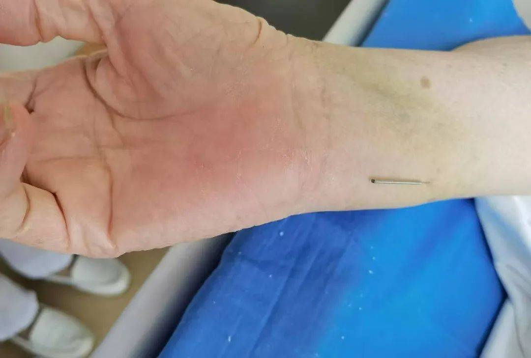 小小腕踝针 尽显大妙用_治疗_针刺_患者