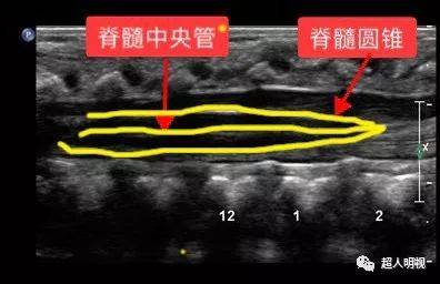 脊髓圆锥的解剖