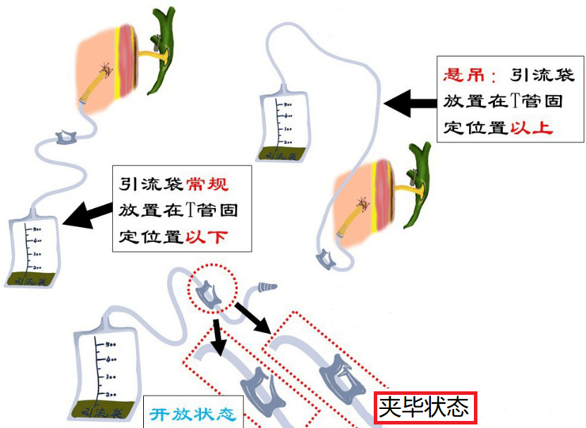 胆总管t型管拔管图图片