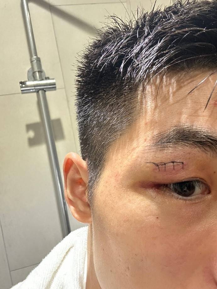 海港中卫魏震社媒晒伤口缝针照:不容易!让我们团结在一起!