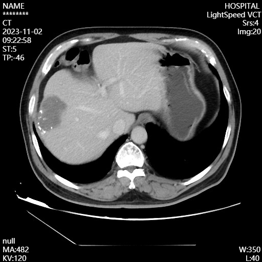 肝癌ct片图片图片