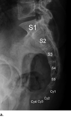 骶尾椎侧位图片