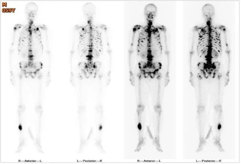 全身骨显像报告解读图片