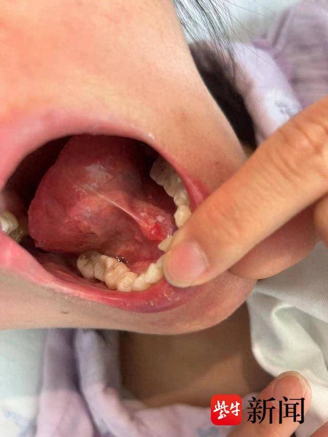 口腔溃疡三个月后,全身多部位溃疡,女子患罕见"白塞病"