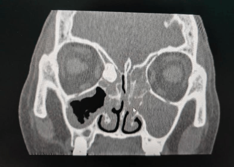 鼻腔骨瘤图片