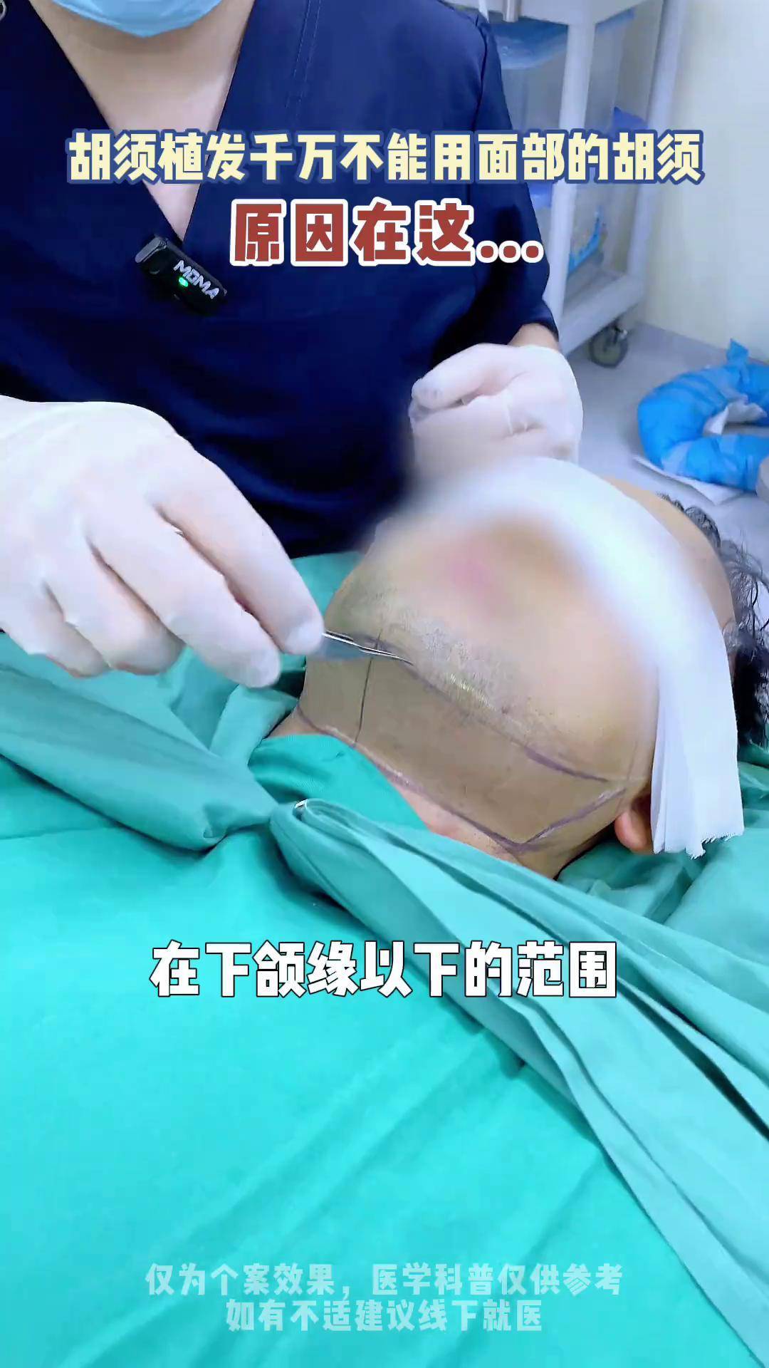 怀孕能植发么(怀孕期间能植发吗)