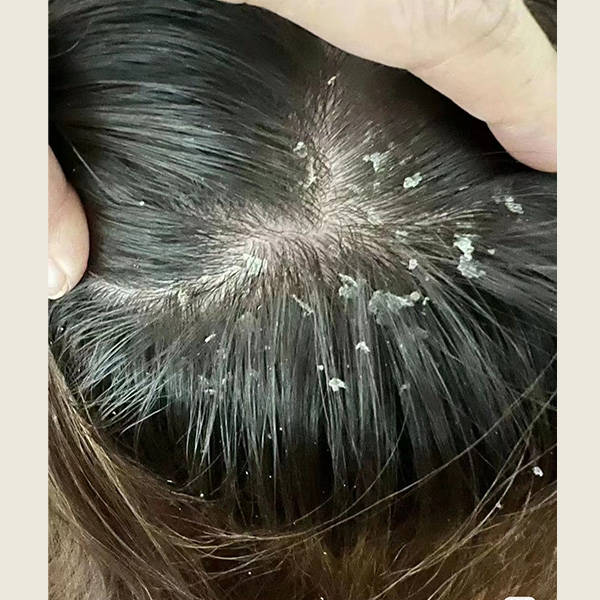 头皮问题产生原因如下:头皮屑的产生与以下因素有关:皮脂分泌:头皮