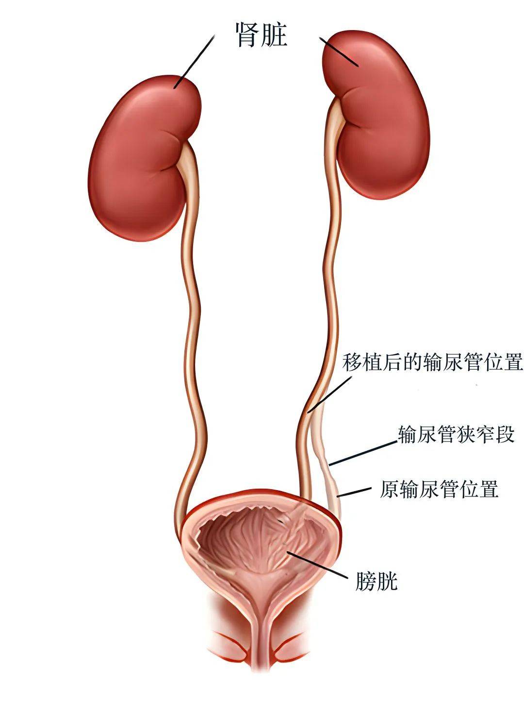 泌尿外科成功攻克输尿管膀胱再植二次修复难关