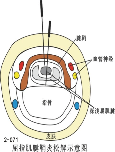 腱鞘结构图片