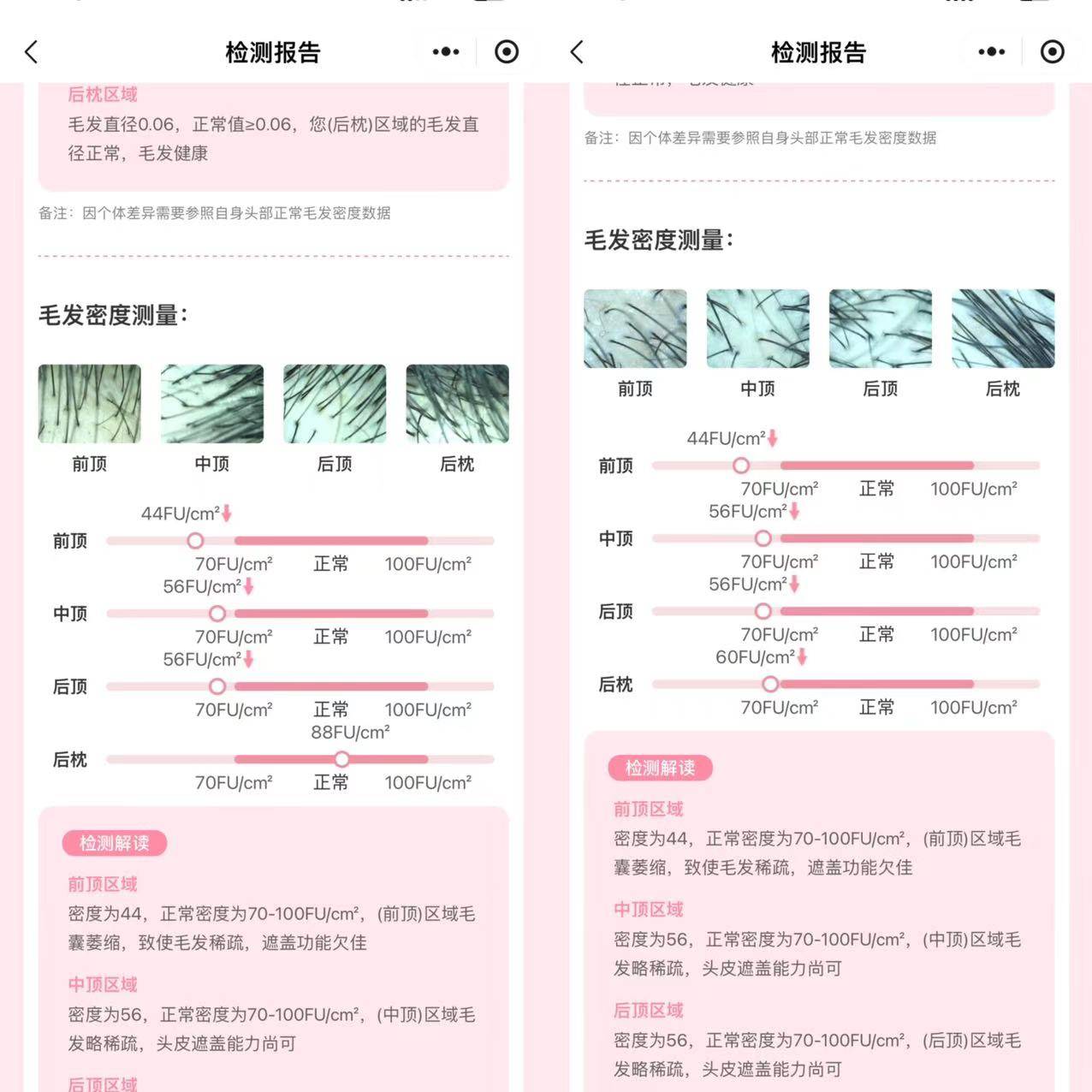 雍禾植发怎么植发
