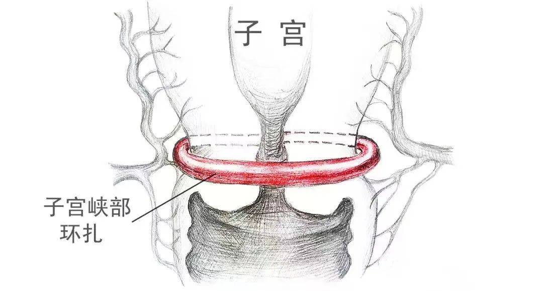 子宫下段形成图片