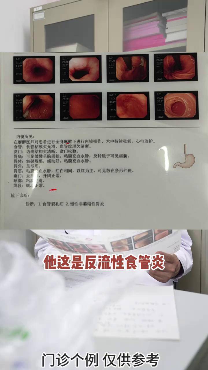 胃食管反流 有什么区别,食管裂孔疝引起的反流,用药副作用太大,该怎么