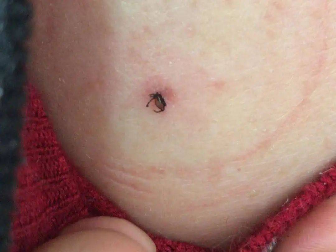 蜱虫活跃期,老太太种菜被叮!还会发生"人传人"