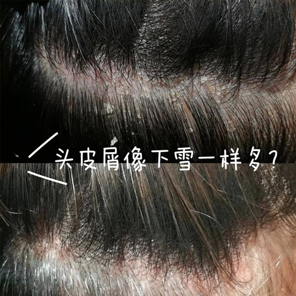 头皮干头痒头屑多用什么洗发水?有效去屑止痒的洗发水推荐_护发_秀发_问题