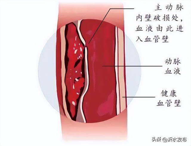 这根心脏“长”出的血管，10月最易破裂(图3)