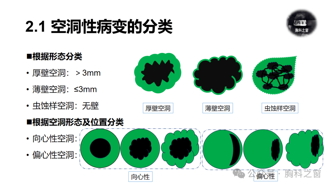 癌性空洞图片