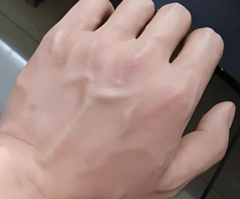 而静脉留置针的软管也会随着手部活动发生轻微改变,即导致输液不畅的