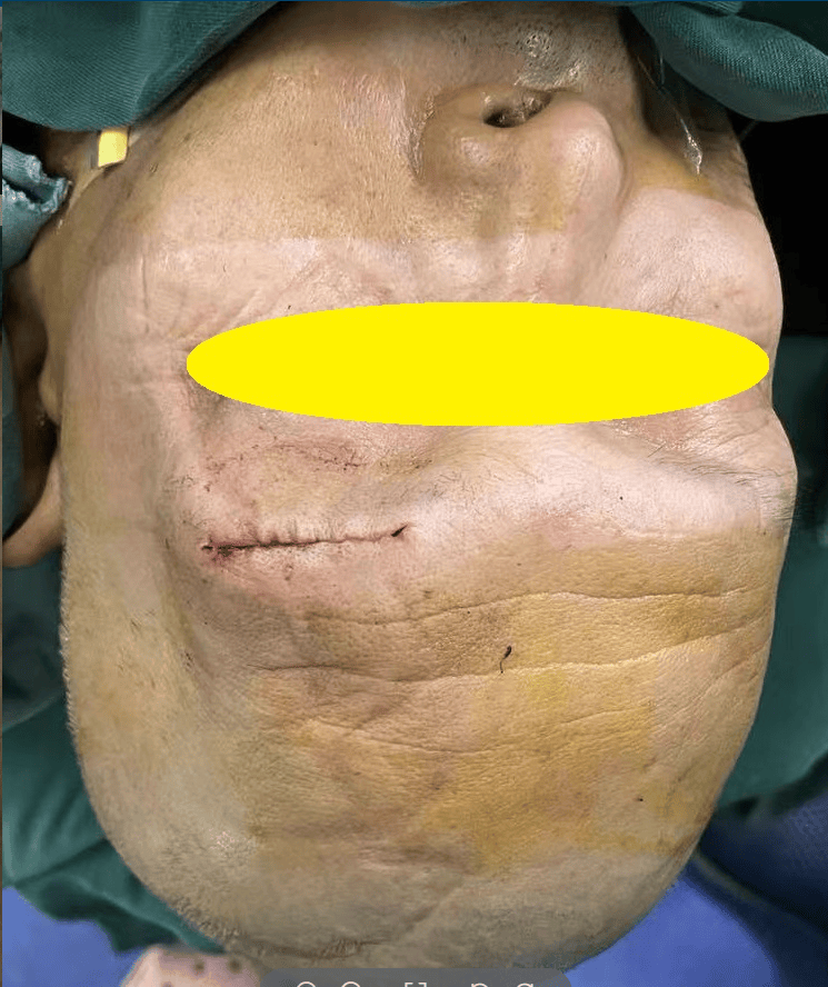 由于患者既往有颅脑手术及颅骨修补病史,如果常规冠状切口开颅清除