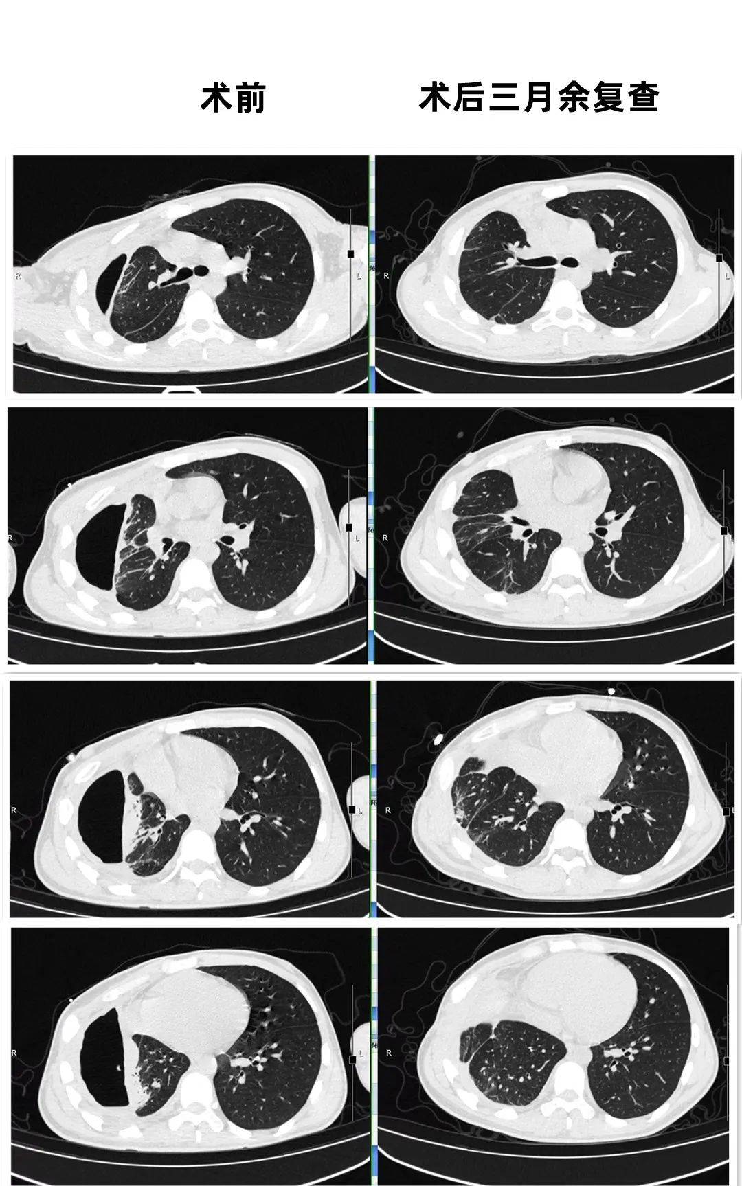 "患难兄弟"的脓胸治疗在肺科医院实现转机