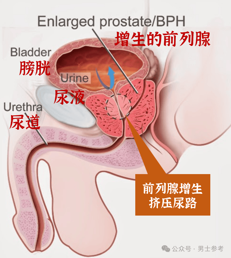 为什么前列腺会变大?有5个习惯的人要小心