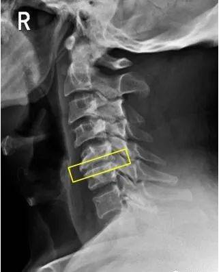 颈椎第五节滑脱图片图片