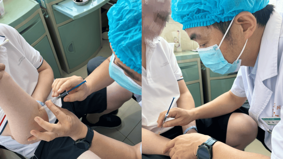 右手屈肌痉挛,给予右侧指深屈肌,指浅屈肌肌肉注射a型肉毒毒素各50u,3