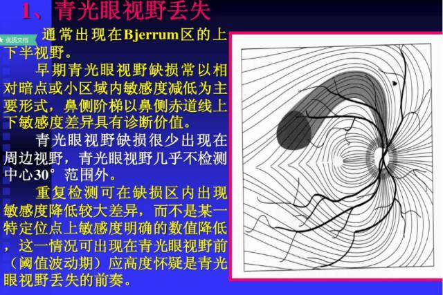 视野检查报告图 解读图片