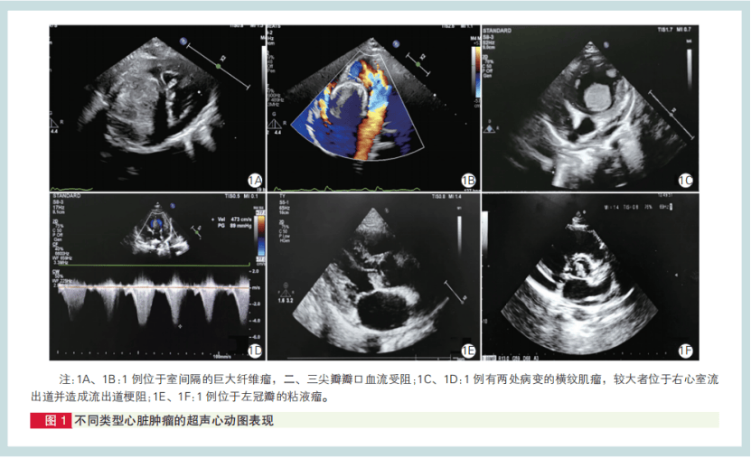 部分小儿心脏肿瘤超声心动图有特征！阜外医院经验总结(图1)