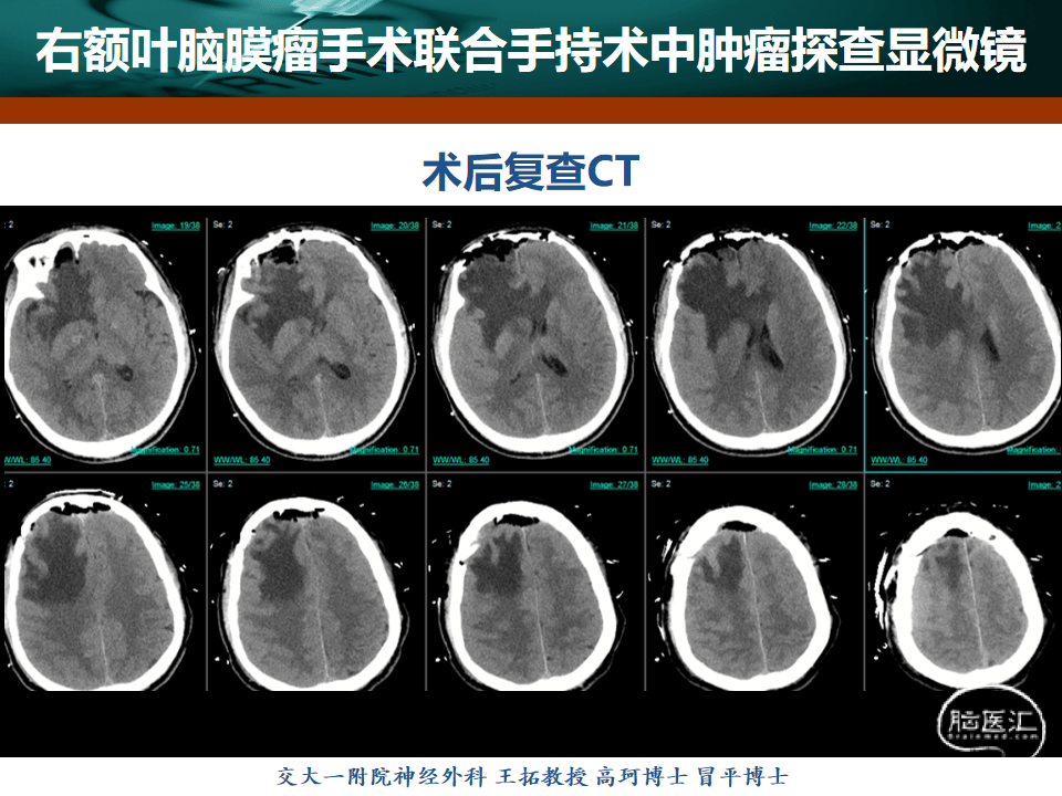 病例分享 王拓教授团队 右额叶脑膜瘤手术联合手持术中肿瘤探查