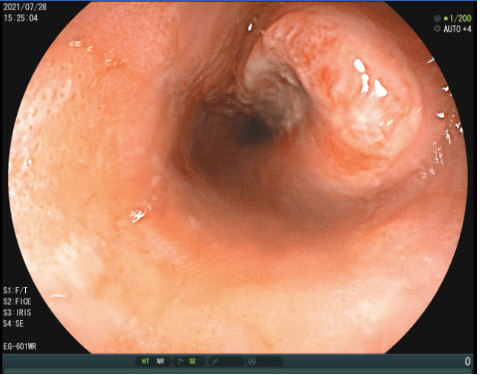 食管癌早期胃镜下图片图片