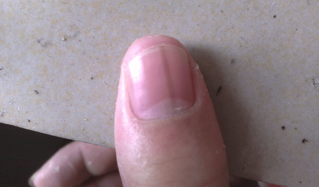 而指甲呈现扁平状态的话