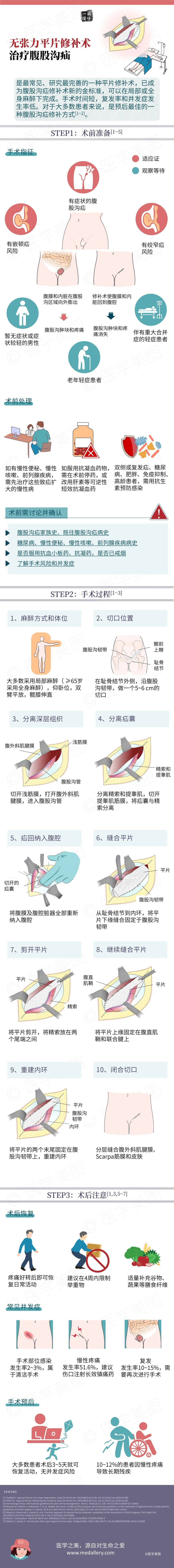 疝气无张力修补术图解图片