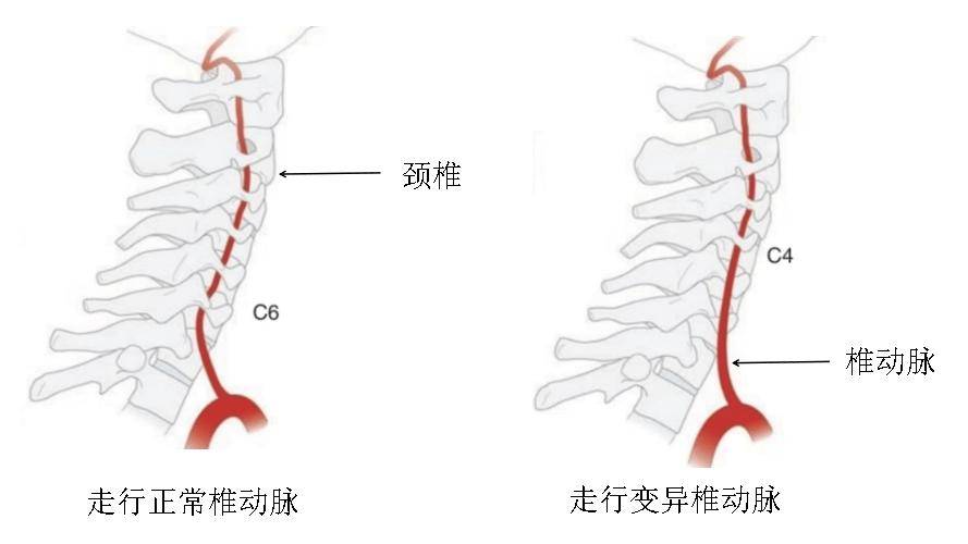 椎动脉变异图片