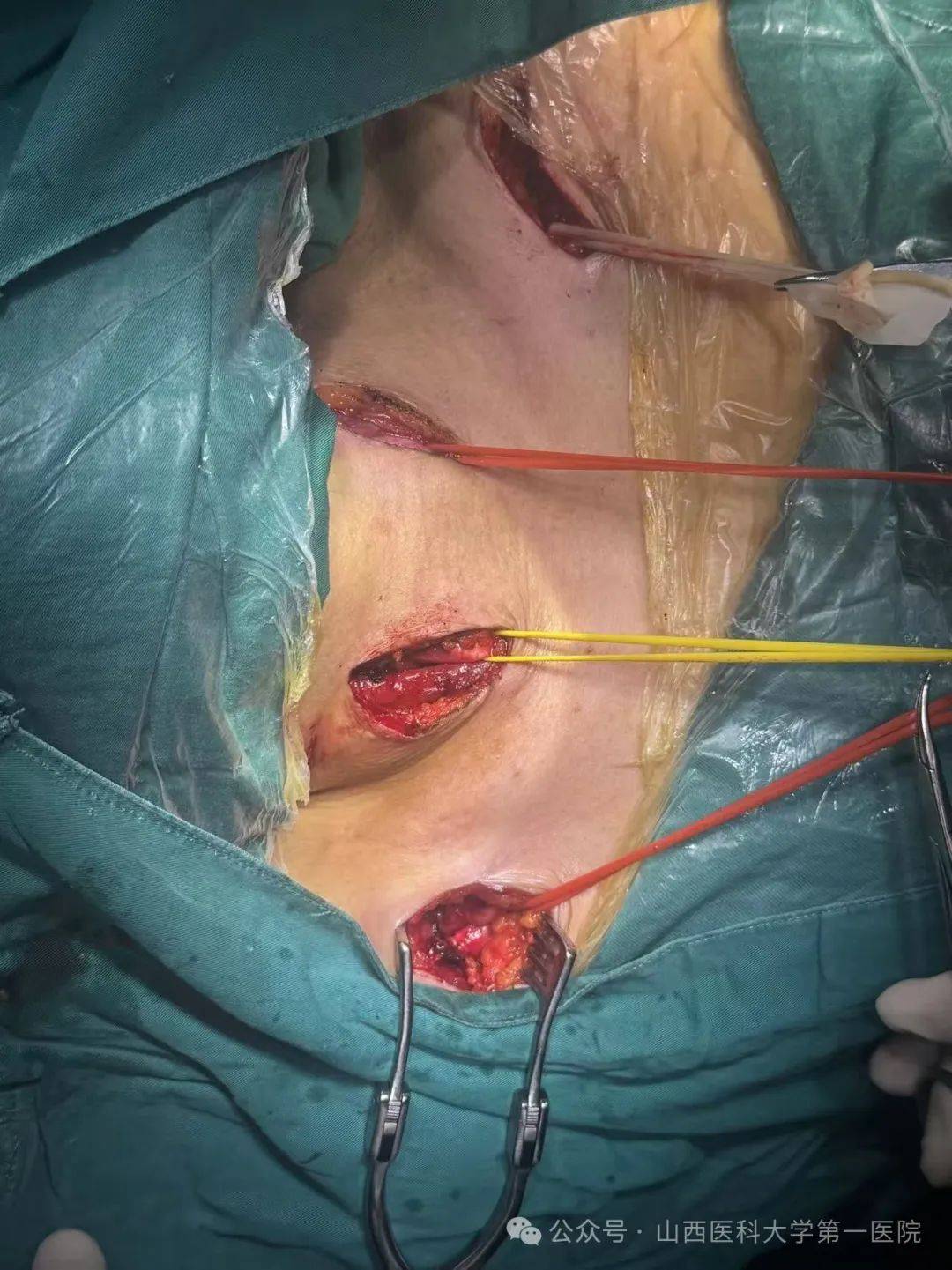 医科大学第一医院心脏大血管外科成功为主动脉夹层患者实施"杂交手术"