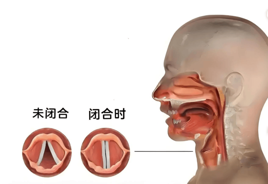 声门裂图片图片