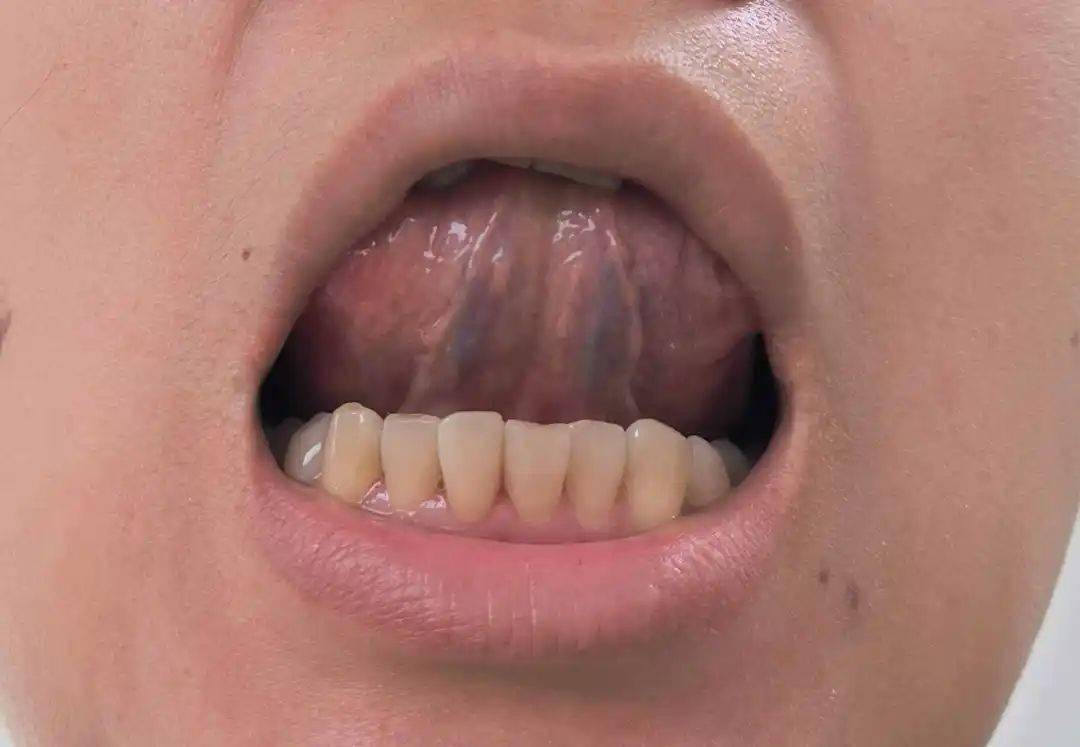 舌下血管粗大,月经量少拖尾,气滞血瘀的食疗方案