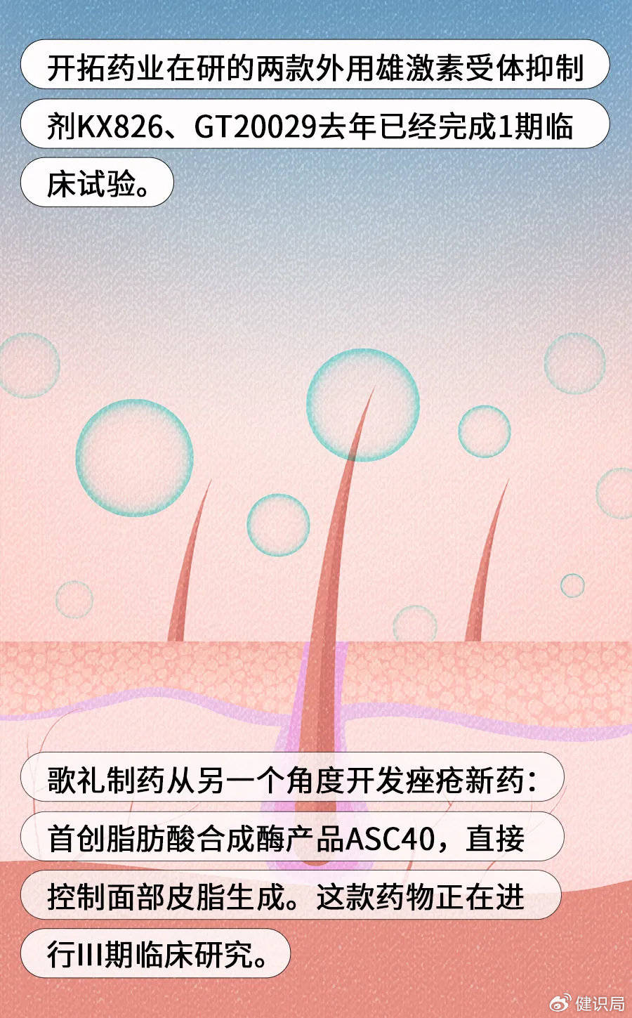 痤疮的形成受多种因素影响,比如角质细胞过度增殖,皮脂腺分泌过多