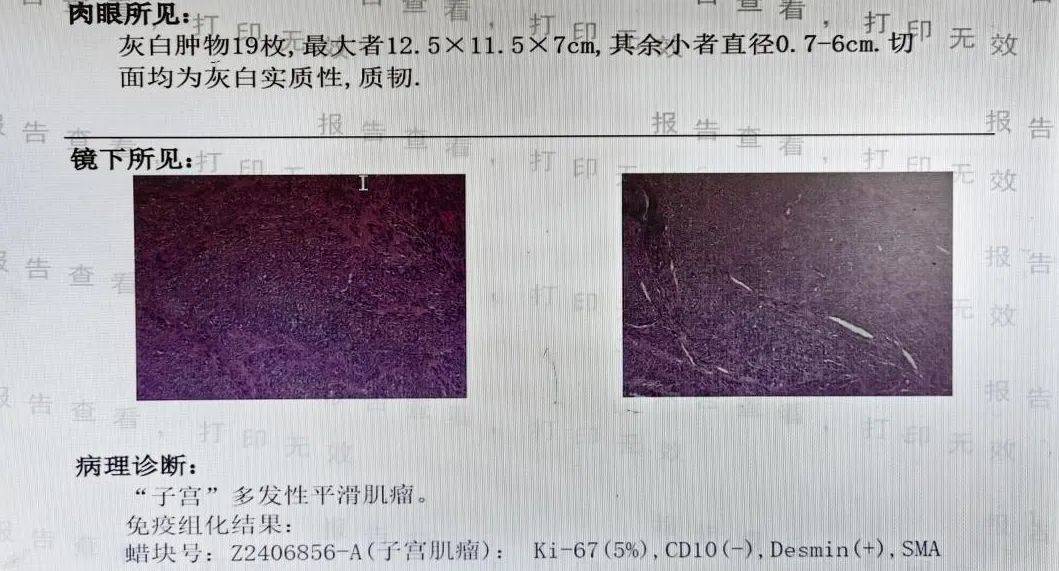 患者_子宫_症状