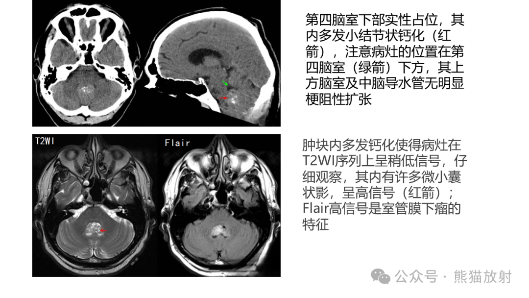 省立读片丨青年人四脑室肿瘤