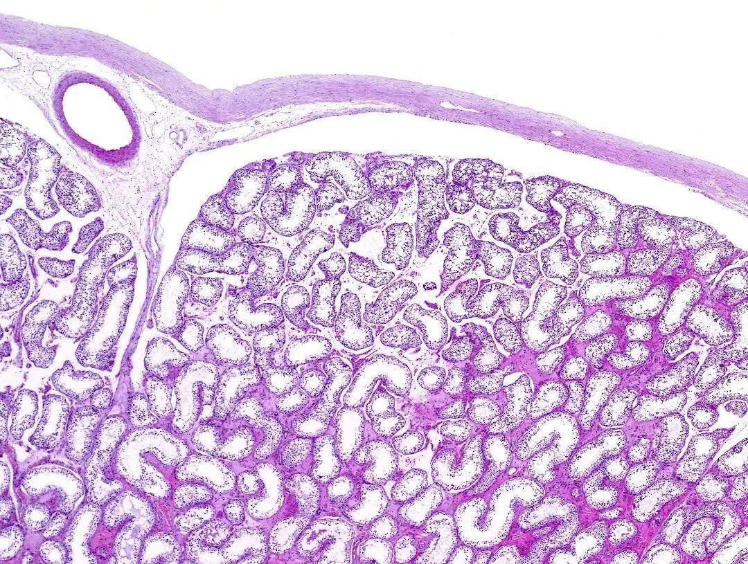 杨岚:检查发现,流产胚胎染色体为47,xxy,比正常者多了一条x染色体.
