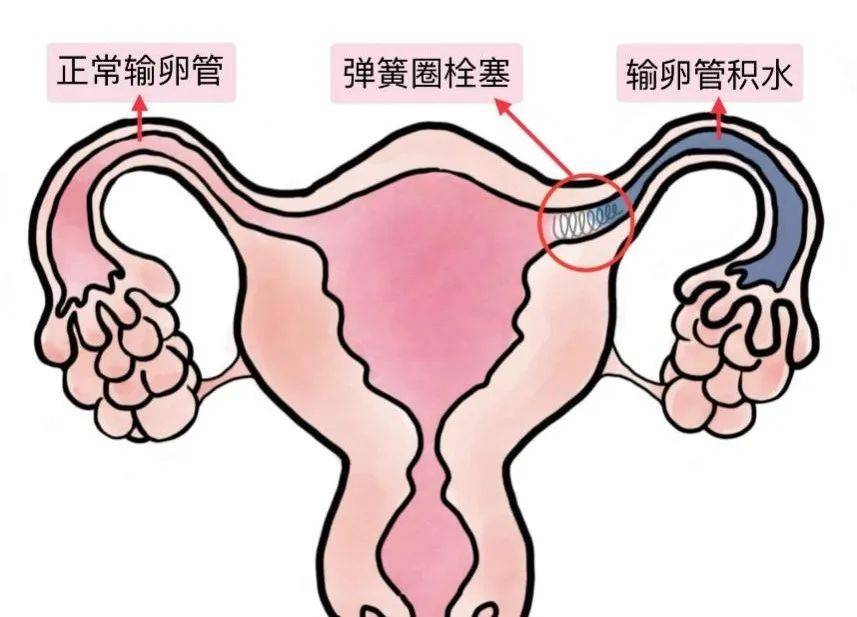 输卵管形状介绍图图片