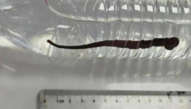 普洱一7岁幼童做雾化时咳出12cm活体蚂蟥