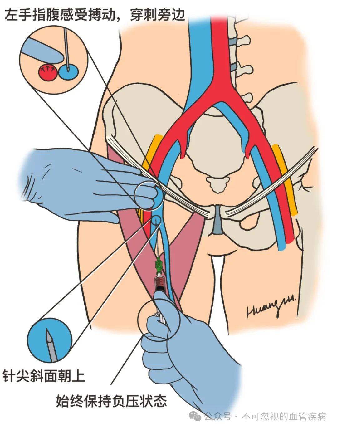 静脉穿刺的位置图解图片